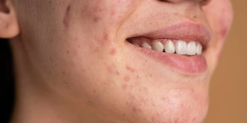 Pores